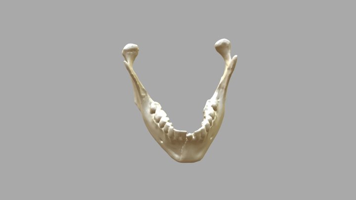 Mandible fracture: Symphysis / Condylar process 3D Model