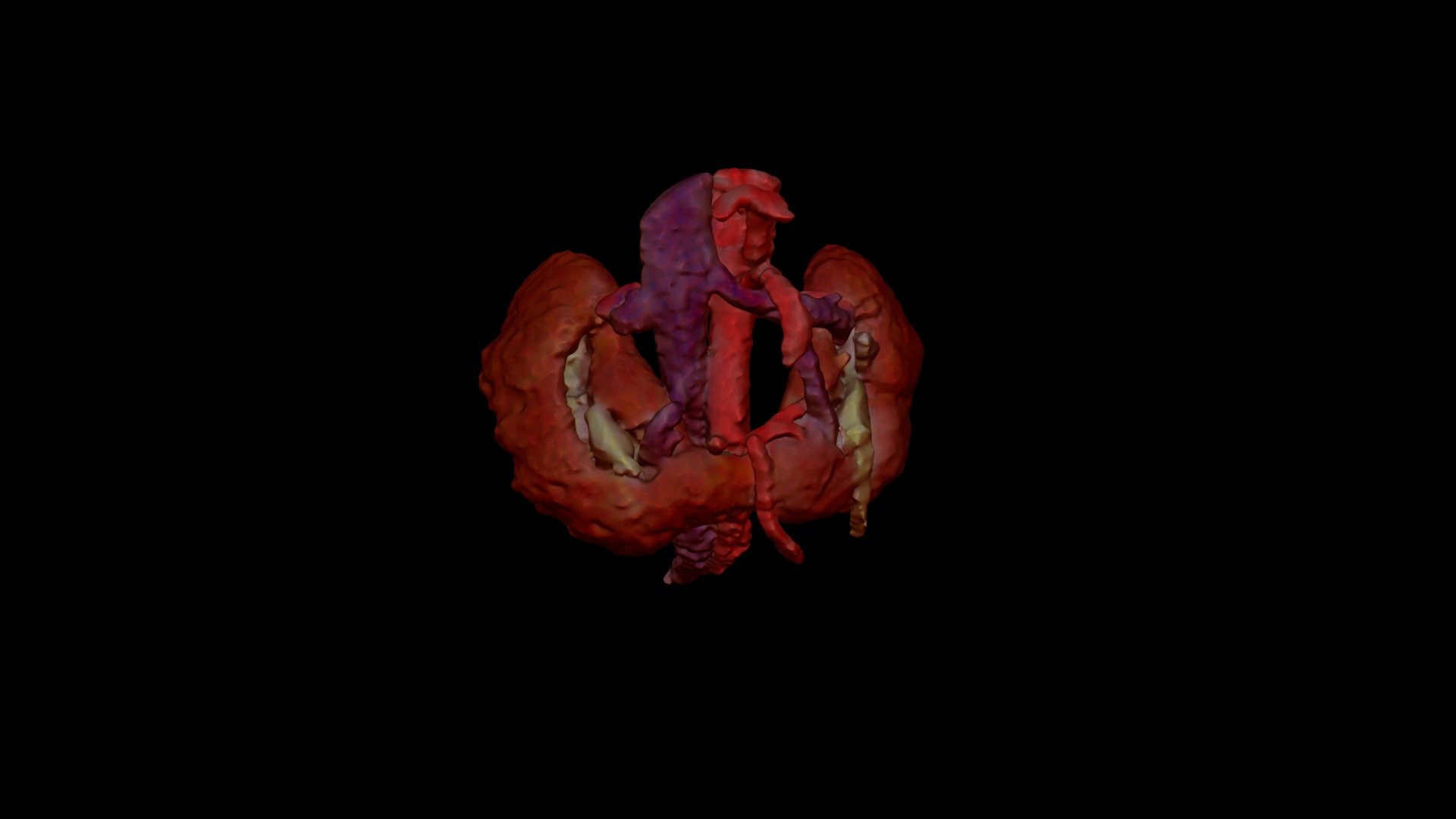 Horseshoe Kidney