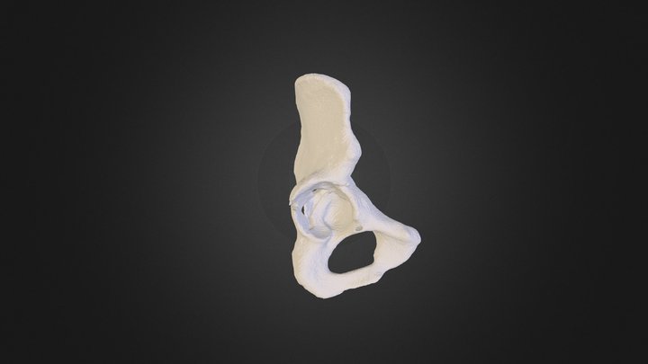 Acetabular Fracture 3D Model