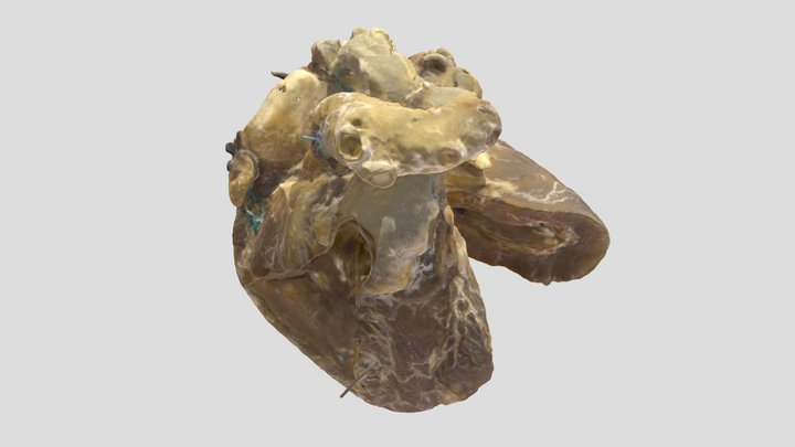 Tetralogy of Fallot_A7726 3D Model