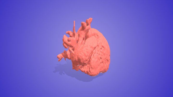 Sinus Venosus Defect 3D Model