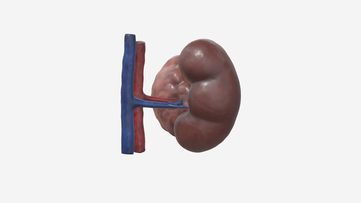 Kidney Cancer - Medium Sized Tumour 3D Model
