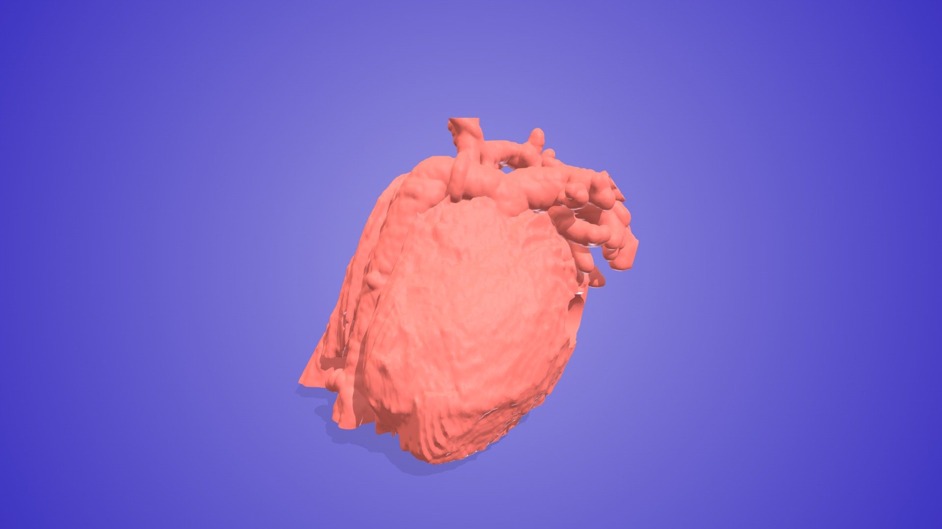Influenza Myocarditis