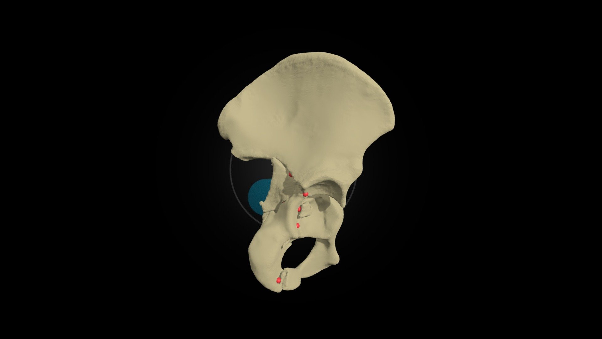 HumanX Acetabulum Fracture right #003 - 3D model by HumanX Medical ...