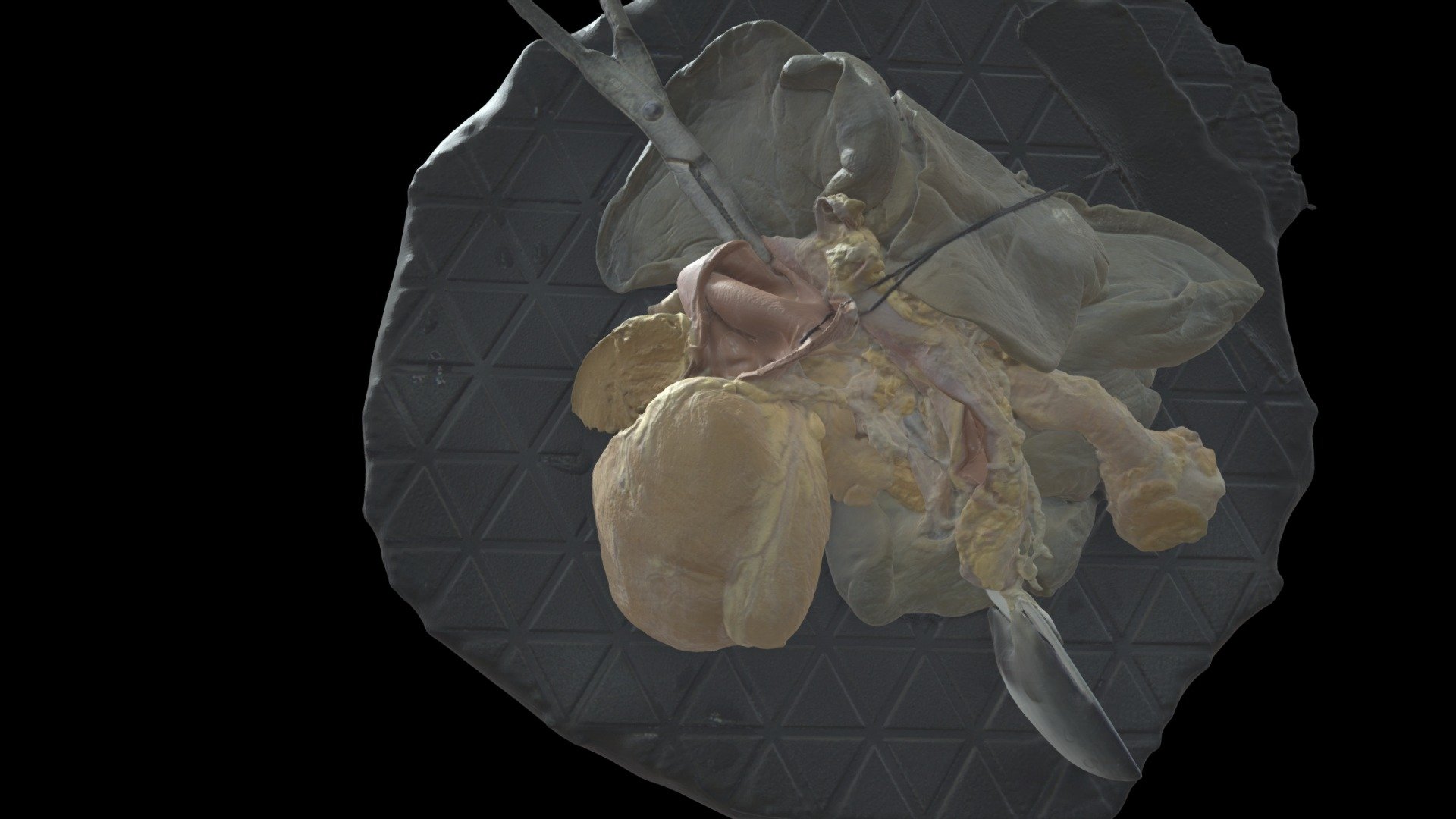 Pulmonary atresia with VSD ach-15 - 3D model by Rohit Loomba (@loomba ...