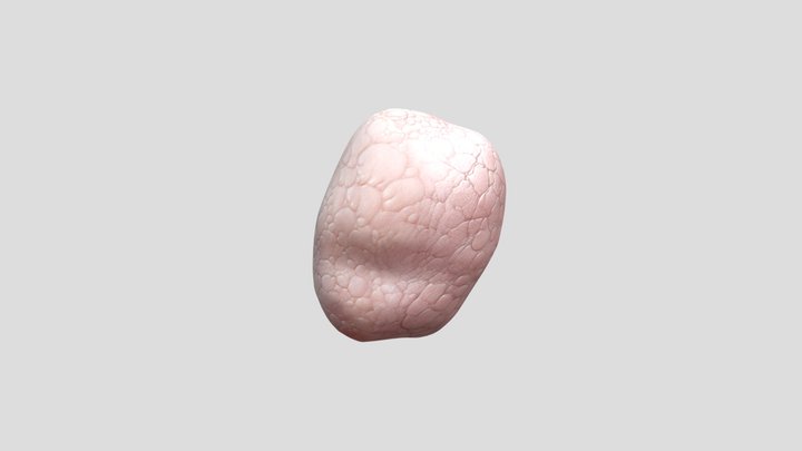 Tumour_at_the_kidney_ 3D Model