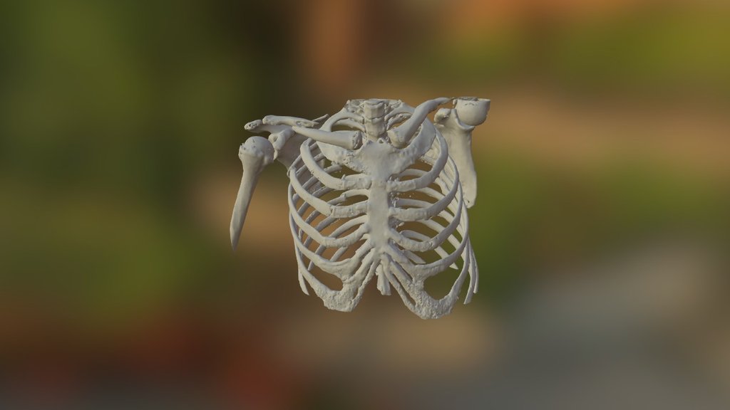 Rib Fracture-1 - 3D model by FablabNDMC [d1efb4f] - Sketchfab