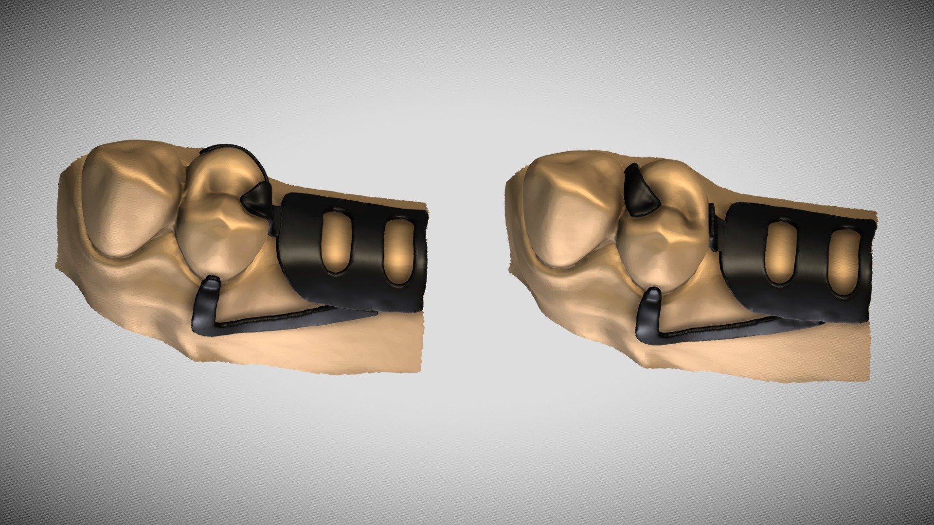 Reciprocation in Bar Clasps - Download Free 3D model by Muhammad Nabeel ...
