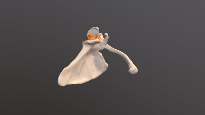 Guia cirúrgico de ombro (caso glenoide) 3D Model