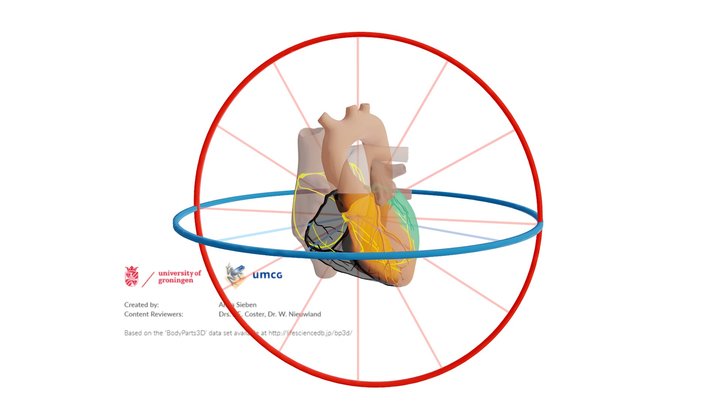 Proximaal infarct RCA met Afleidingen – Modello 3D gratuito STL
