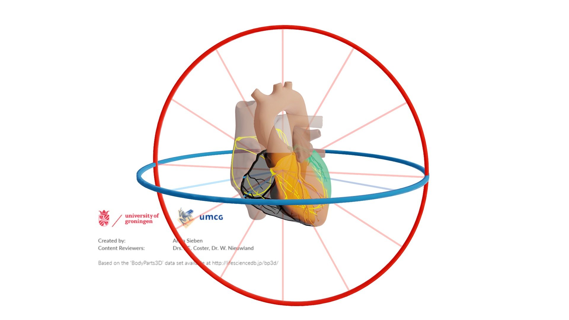Proximaal infarct RCA met Afleidingen