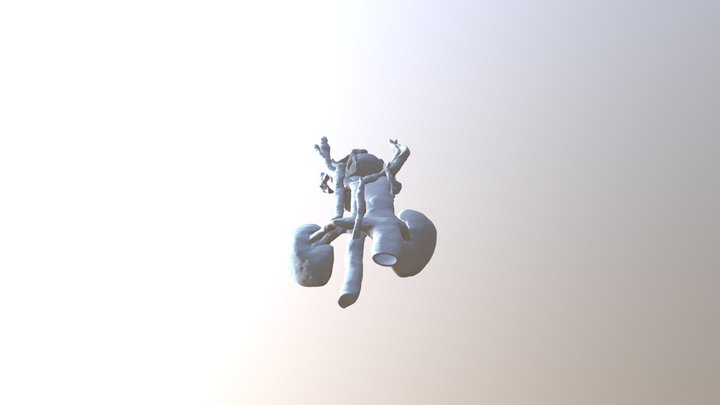 Model of Pelvic Congestion Syndrome 3D Model
