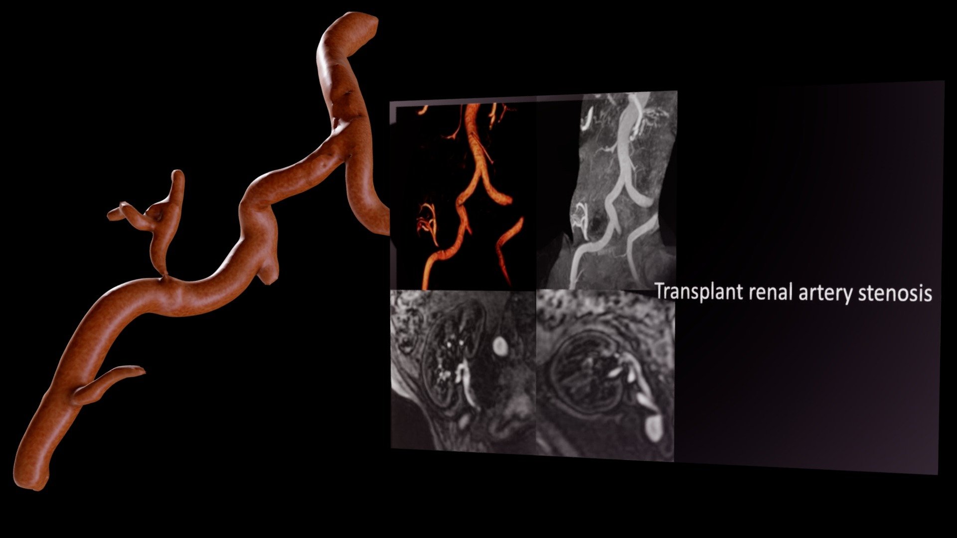 Transplant Renal Artery Stenosis