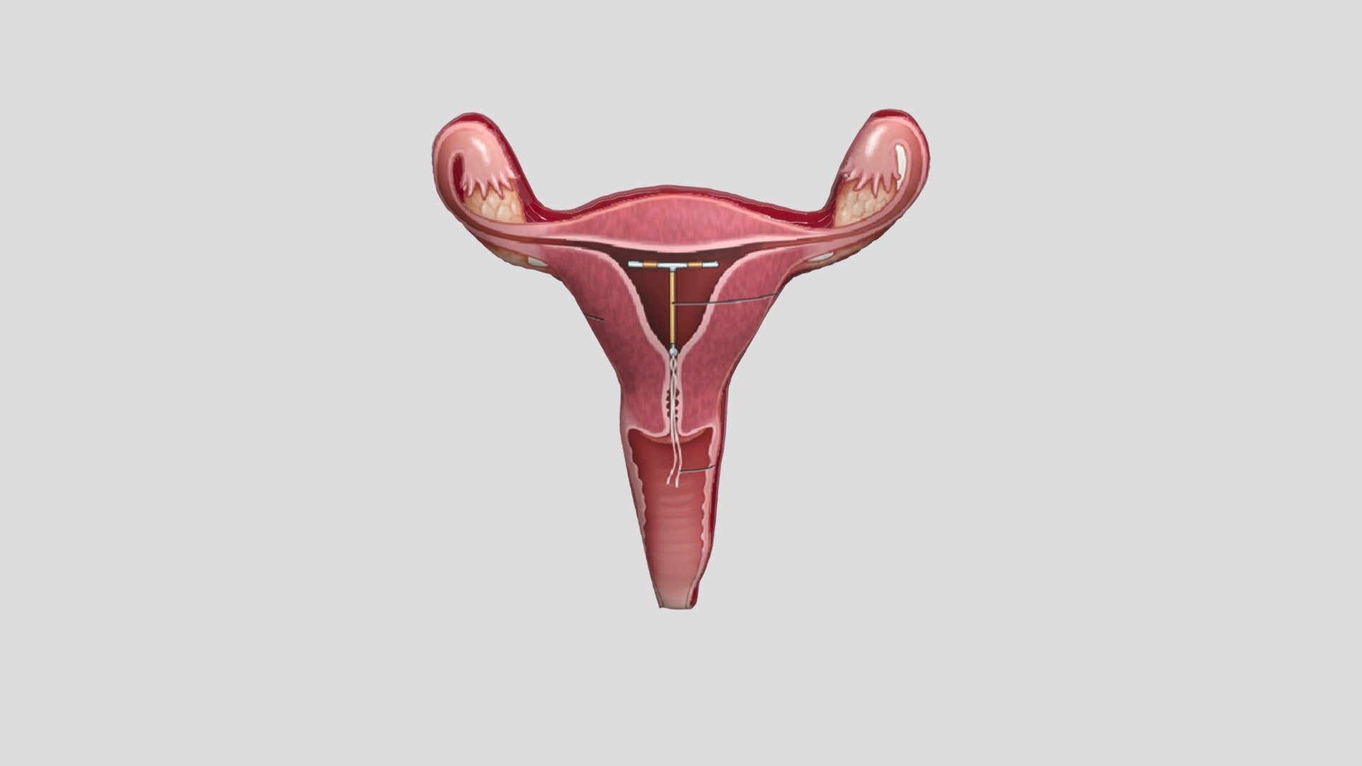 AKDR didalam Uterus