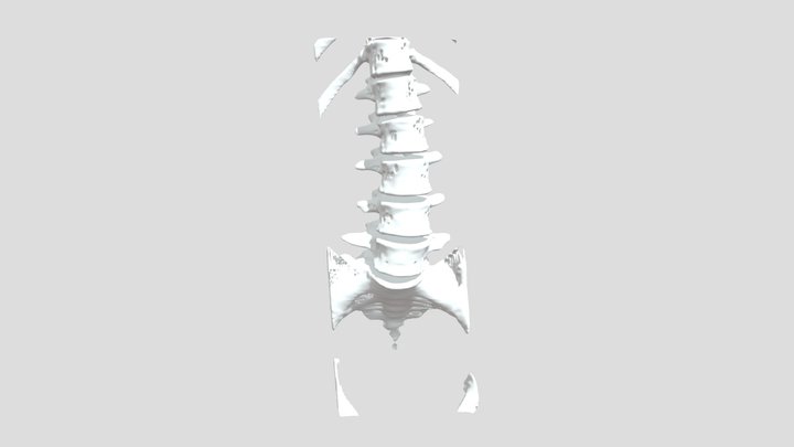 s/p L4-5-S1-S2 laminectomy 3D Model