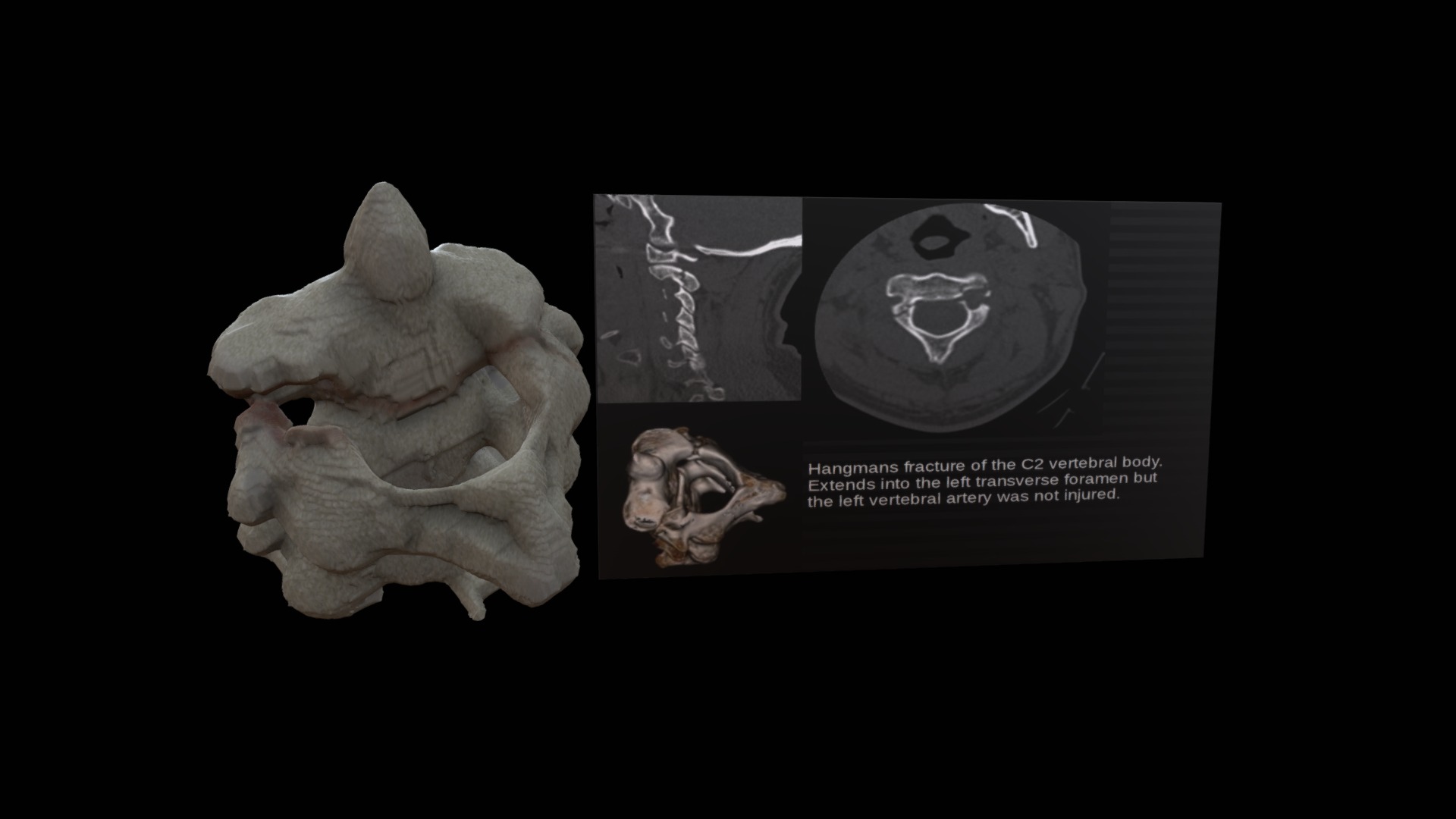 The type III dens fracture and its associated soft-tissue injuries: a  different form of Hangman's fracture The Hangman's fractur, image size:1920x1080