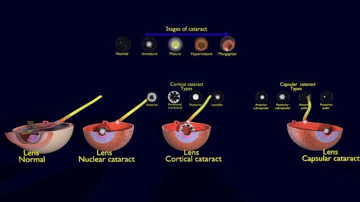 Cataract 3D models - Sketchfab