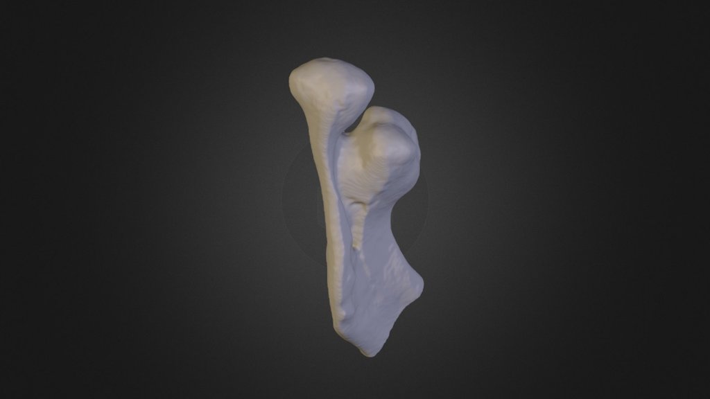 Osteoma
