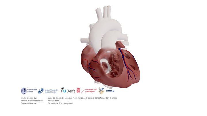 Partial Anomalous Pulmonary Venous Connection – Modello 3D gratuito STL