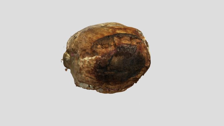 K27 Hematoma 3D Model