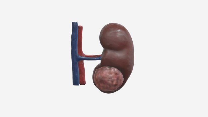 Kidney Cancer - Small Renal Mass Tumour 3D Model