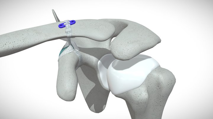 Infinity-Lock™ Button System 3D Model