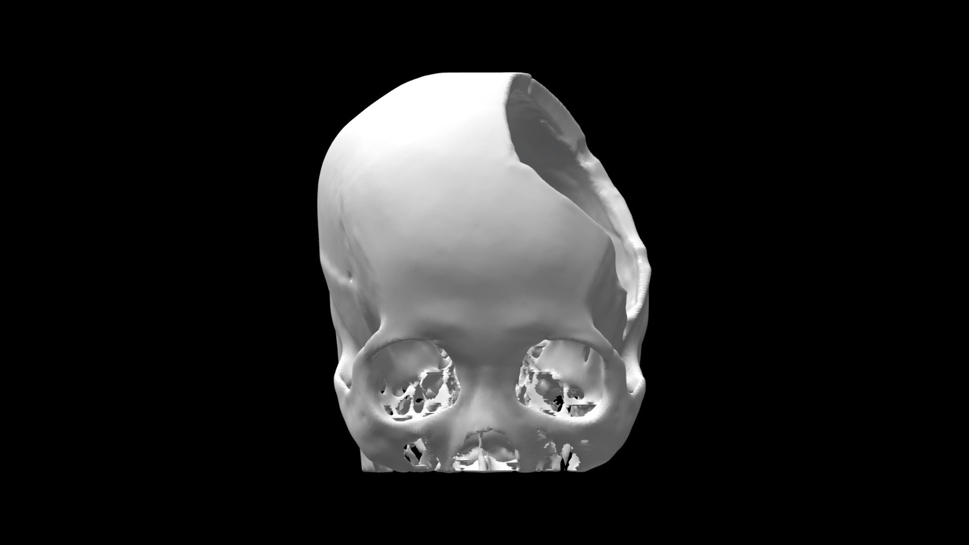Defect d4c28f49db4a4ac5ac292a2b8f787c2a - 3D model by healthgate ...