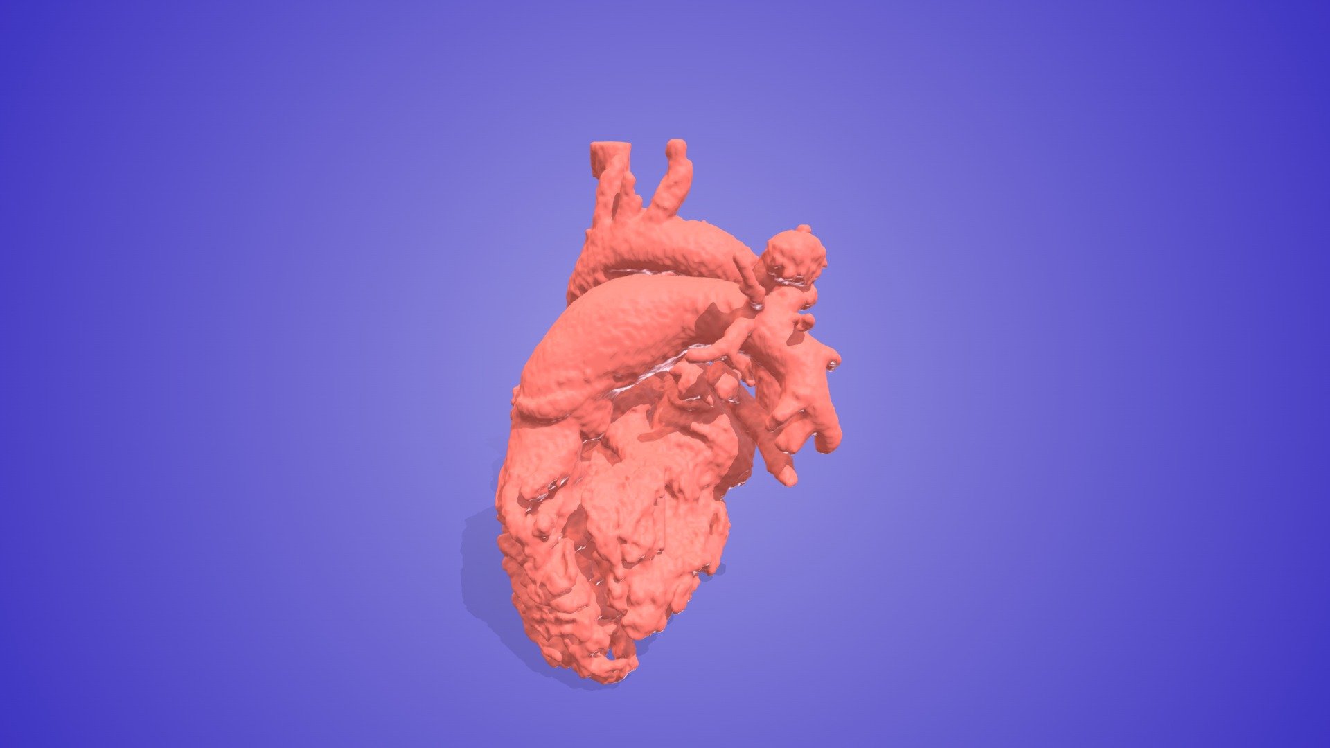 Aortic Aneurysm