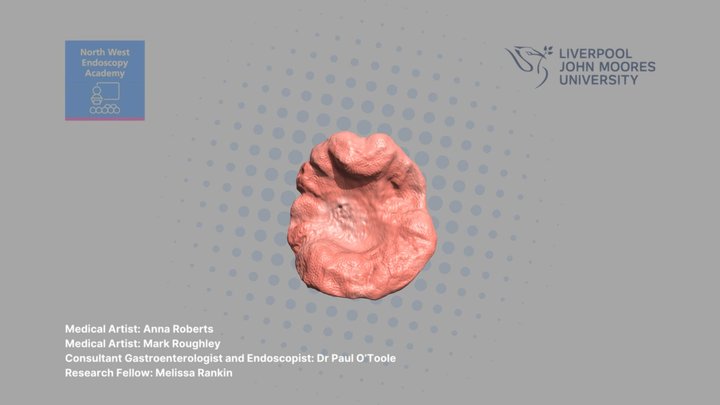 Flat non-granular lesion with depression #2 © 3D Model