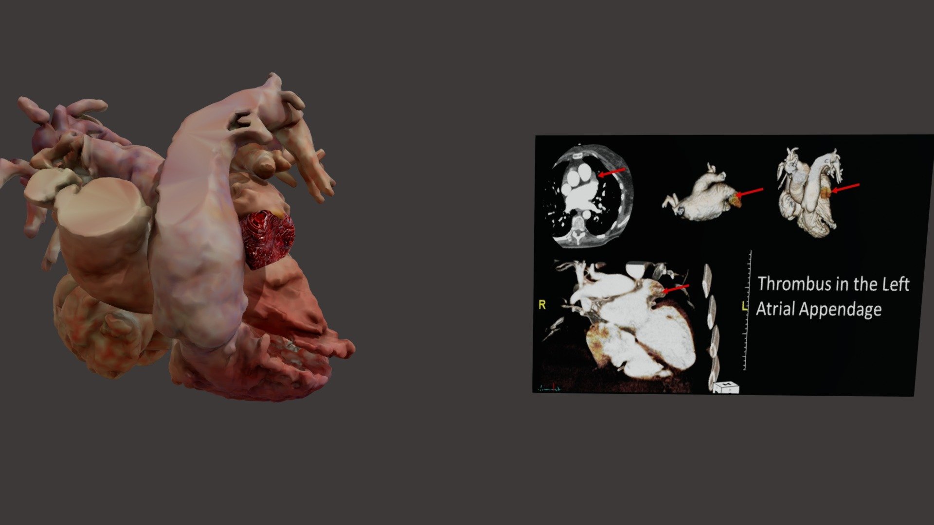 Thrombus Left Atrial Appendage