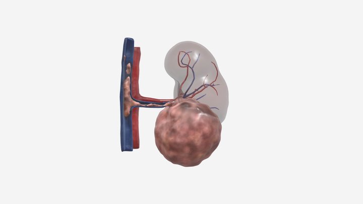 Kidney Cancer - Tumour Thrombosis in IVC 3D Model
