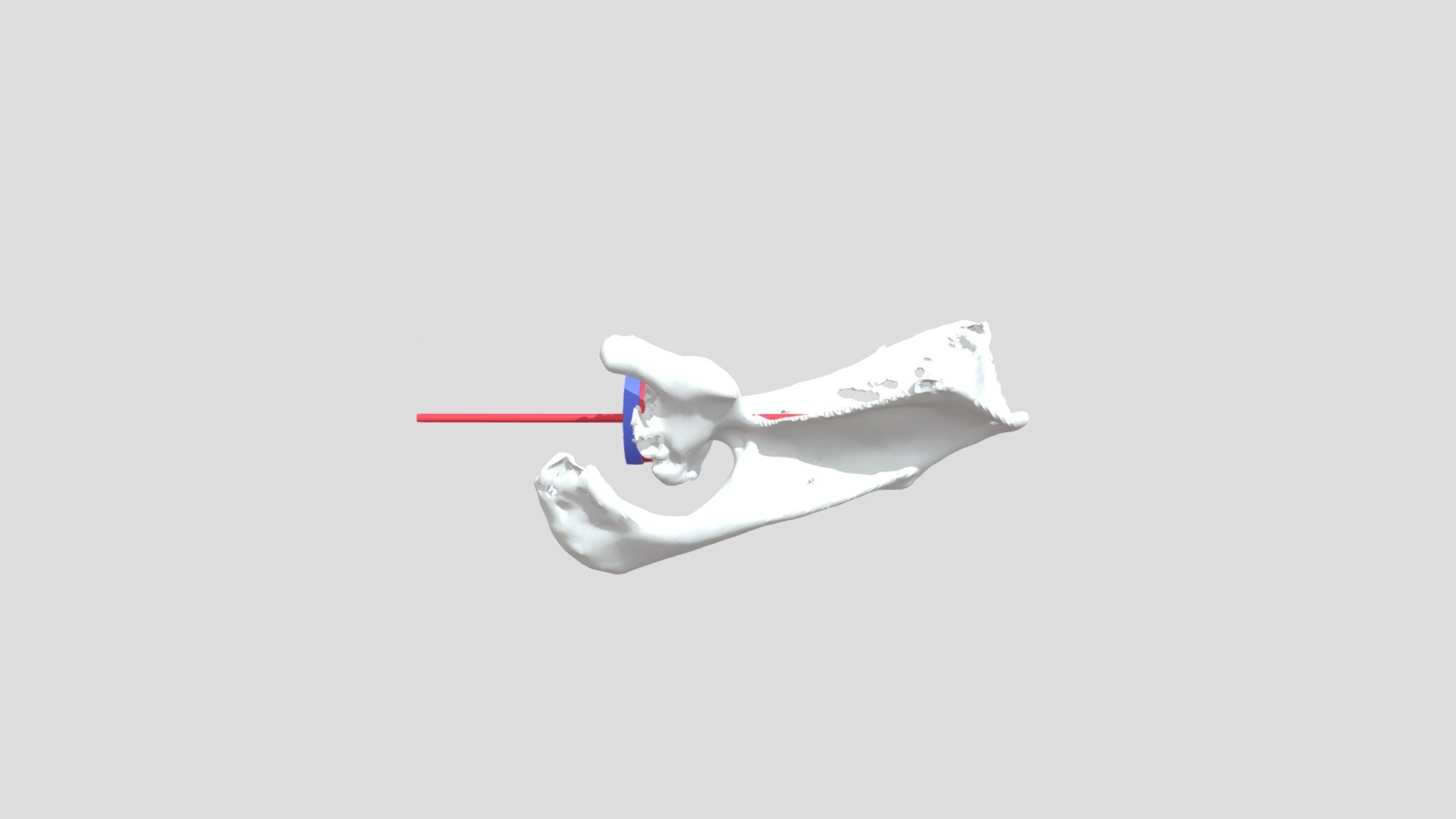 IM - Planejamento - Tornier 25 peg Longo Enxerto — Sketchfab embed 3D viewer