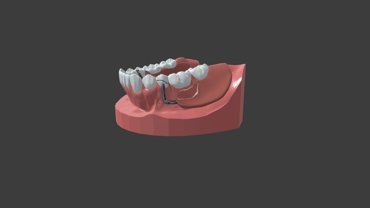 Mandibular  Class I stress release 2 3D Model