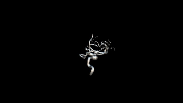 Aneurisma segmento oftálmico-cavernoso ACID 3D Model