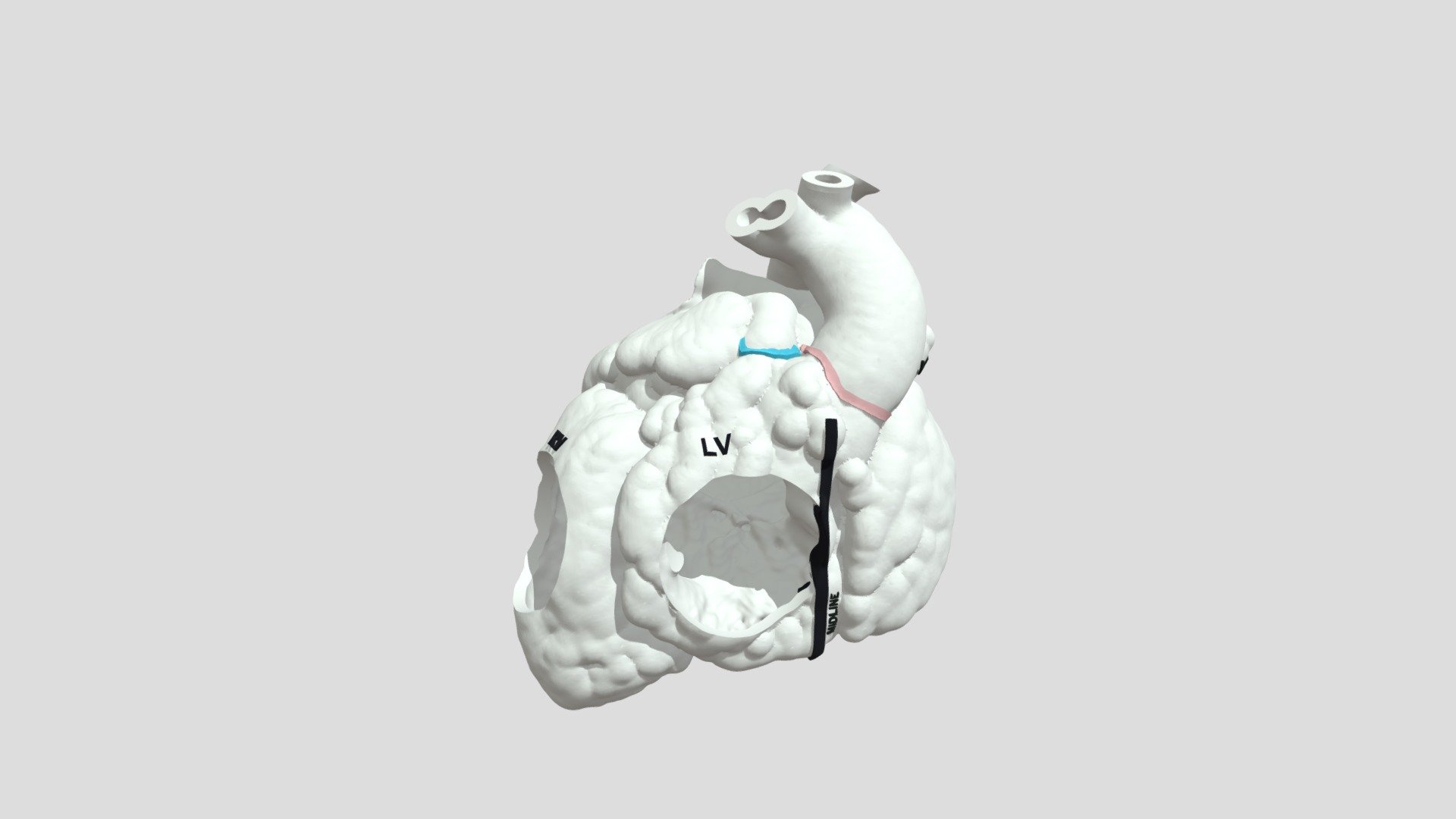 Heterotaxy, Dextrocardia, DORV, CAVC (H0417) - 3D model by NCH Advanced ...