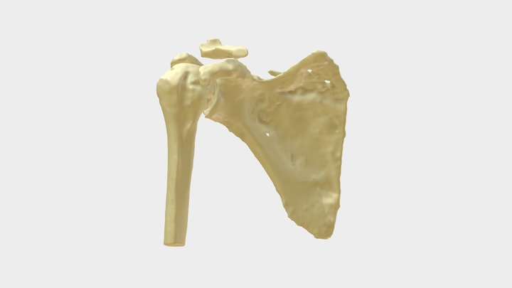 Scapulafraktur 3D Model