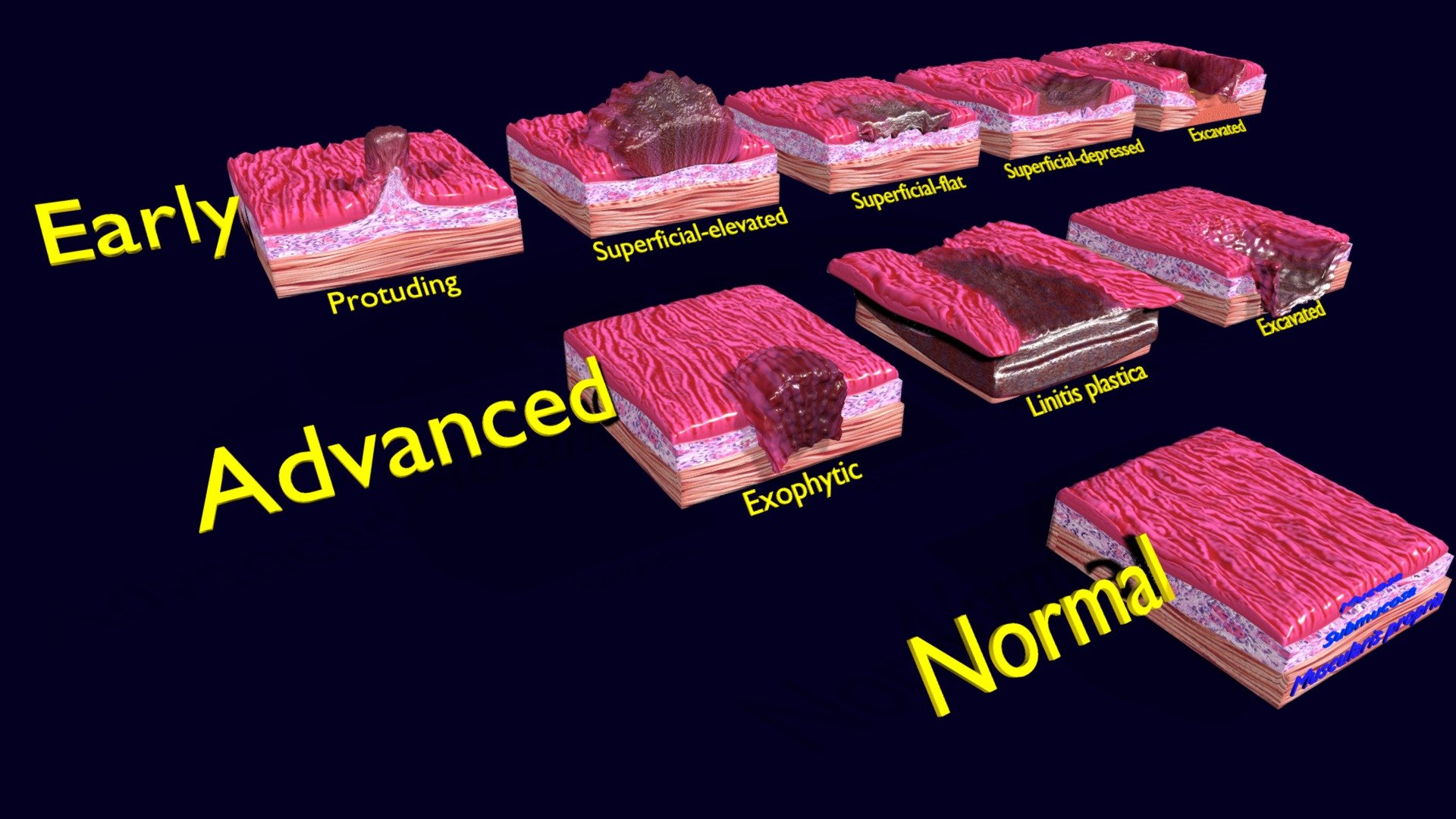 gastric-stomach-cancer-stages-labelled-buy-royalty-free-3d-model-by