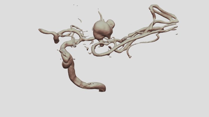 MCA aneurysm 3D Model