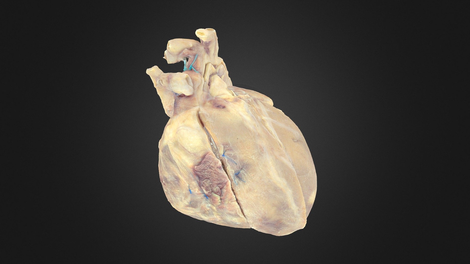 Closed PLC Heart ID 09-1140 - 3D model by UBC Medicine - Educational ...