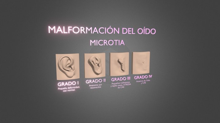 MALFORMACIÓN CONGÉNITA DEL OÍDO - MICROTIA 3D Model
