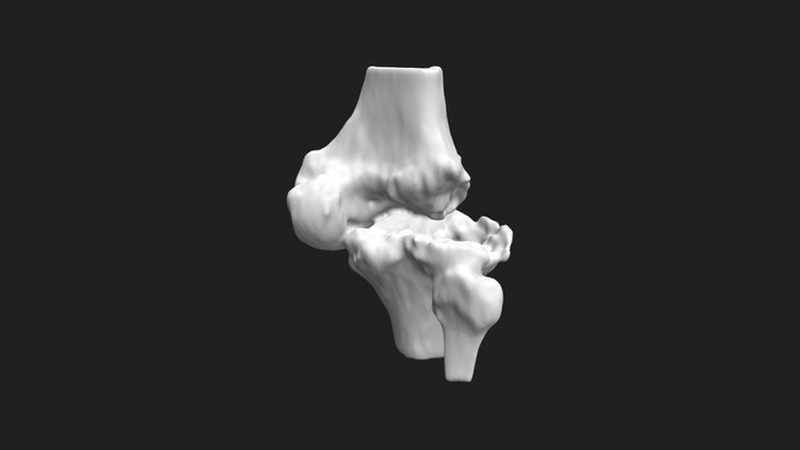 Knee Osteoarthritis Reconstruction 3D Model
