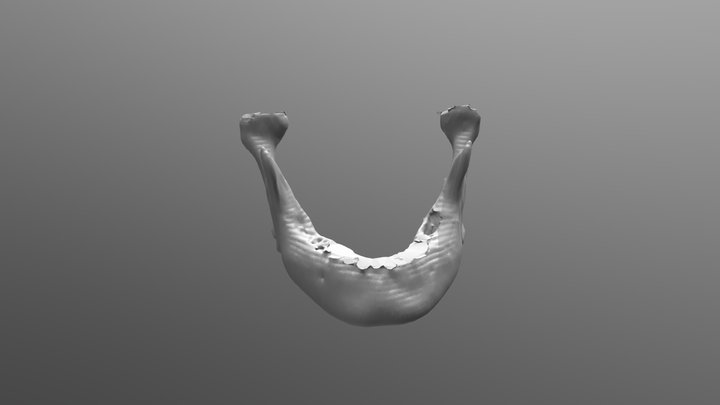 Mandible invaded by squamous cell carcinoma 3D Model