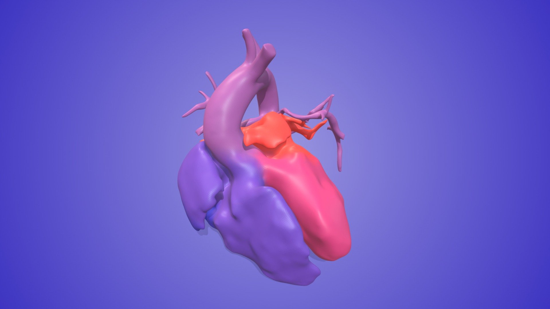 Pulmonary Atresia with VSD and MAPCAs - Download Free 3D model by 3D ...