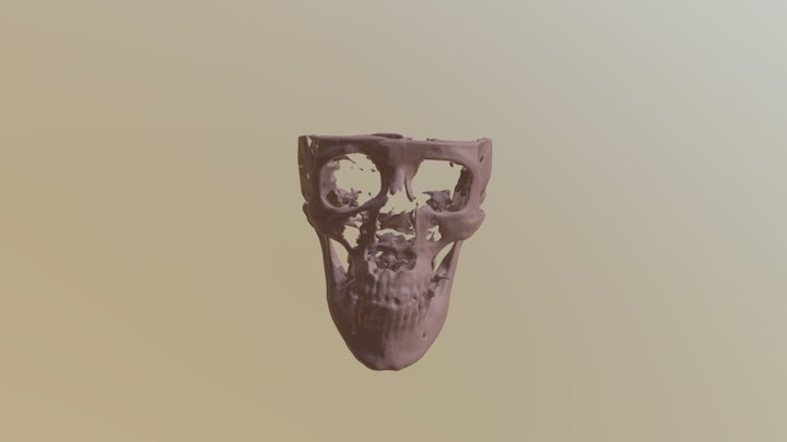 QUISTE NASOPALATINO 3D Model