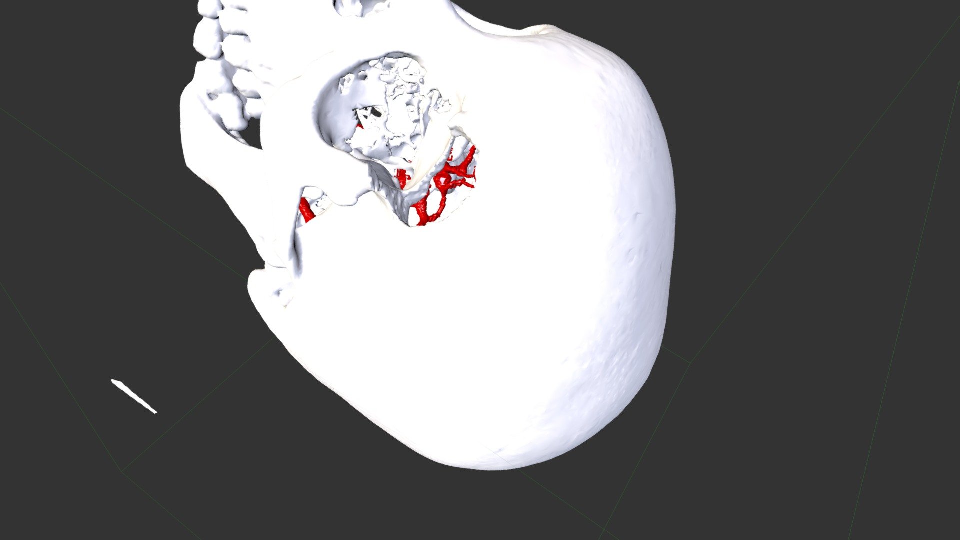 Left mini orbitozygomatic approach - AcoA an