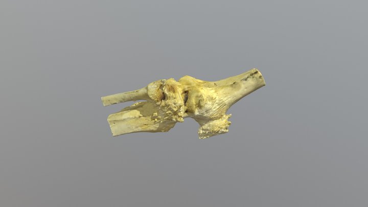 Septic Arthritis - Right femur, patella, tibia 3D Model