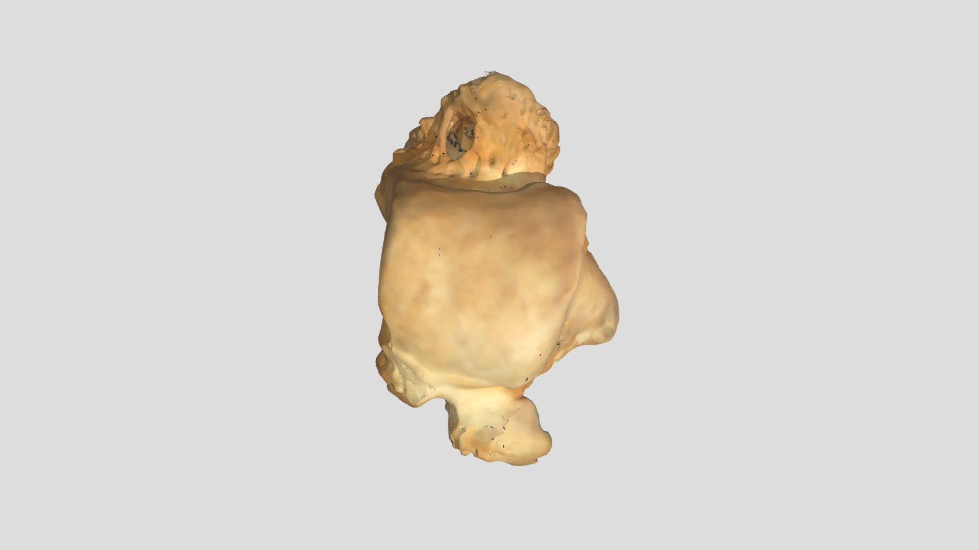 Bone overhang-talus/Nawis kostny-skokowa - 3D model by Digital Imaging ...