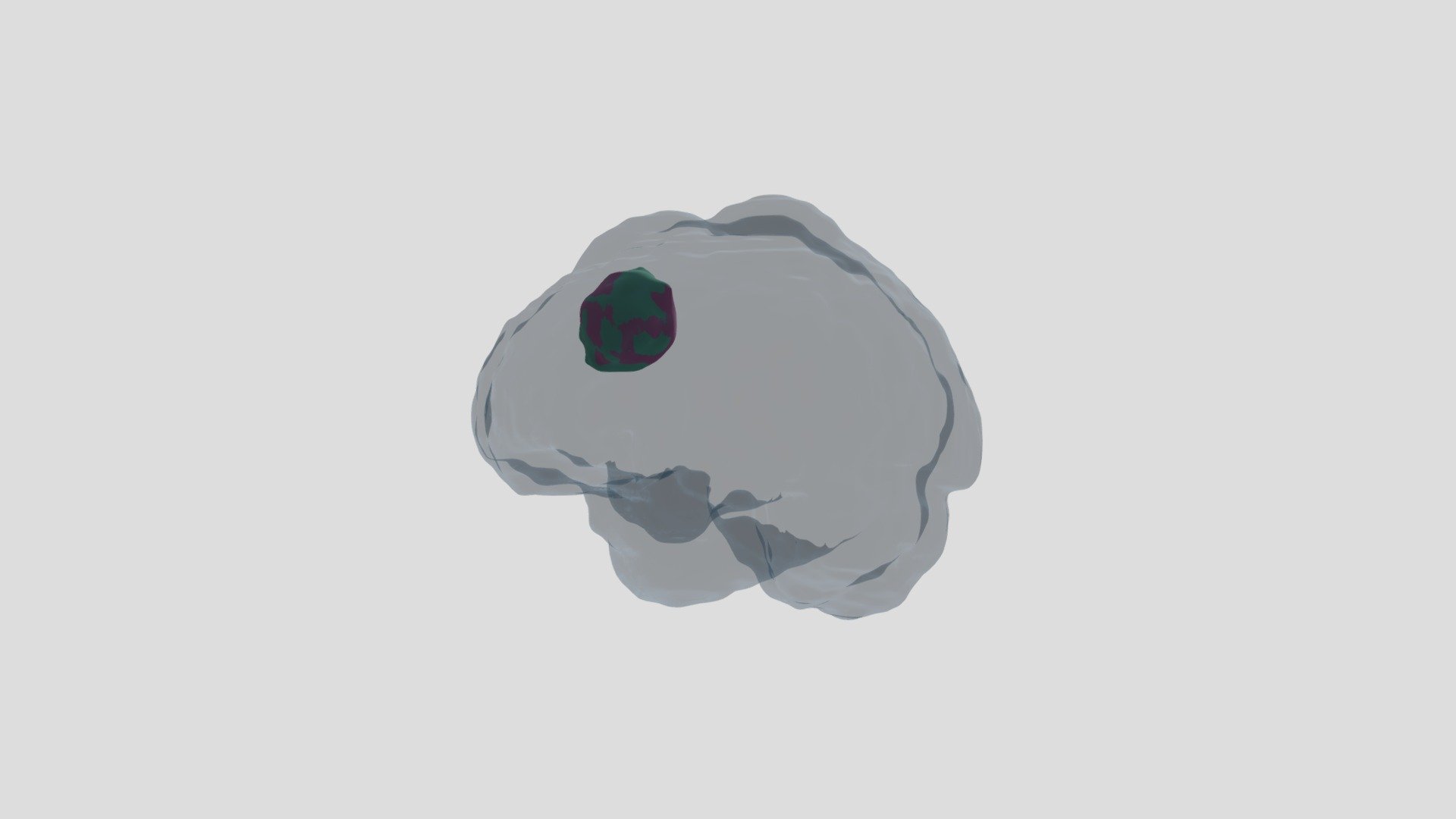 Brain Tumor