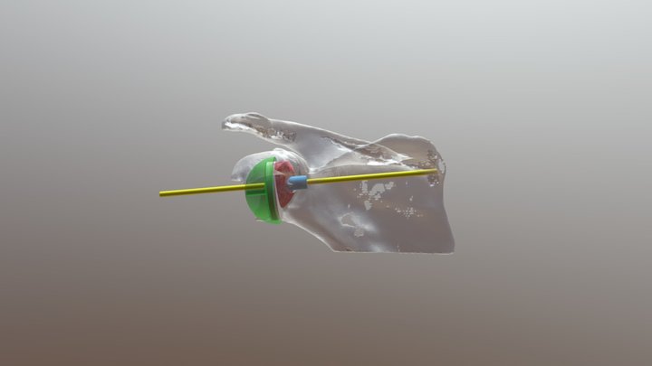 AKDO Total Shoulder Arthroplasty 3D planning 3D Model