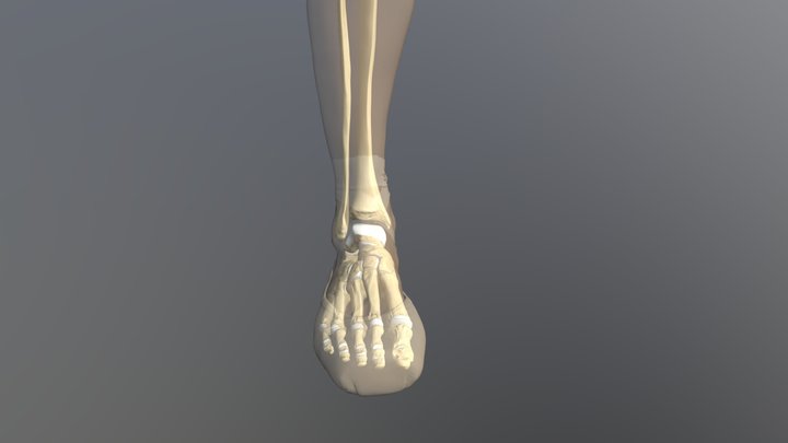 Stress fractures to sesamoid and metatarsals 3D Model